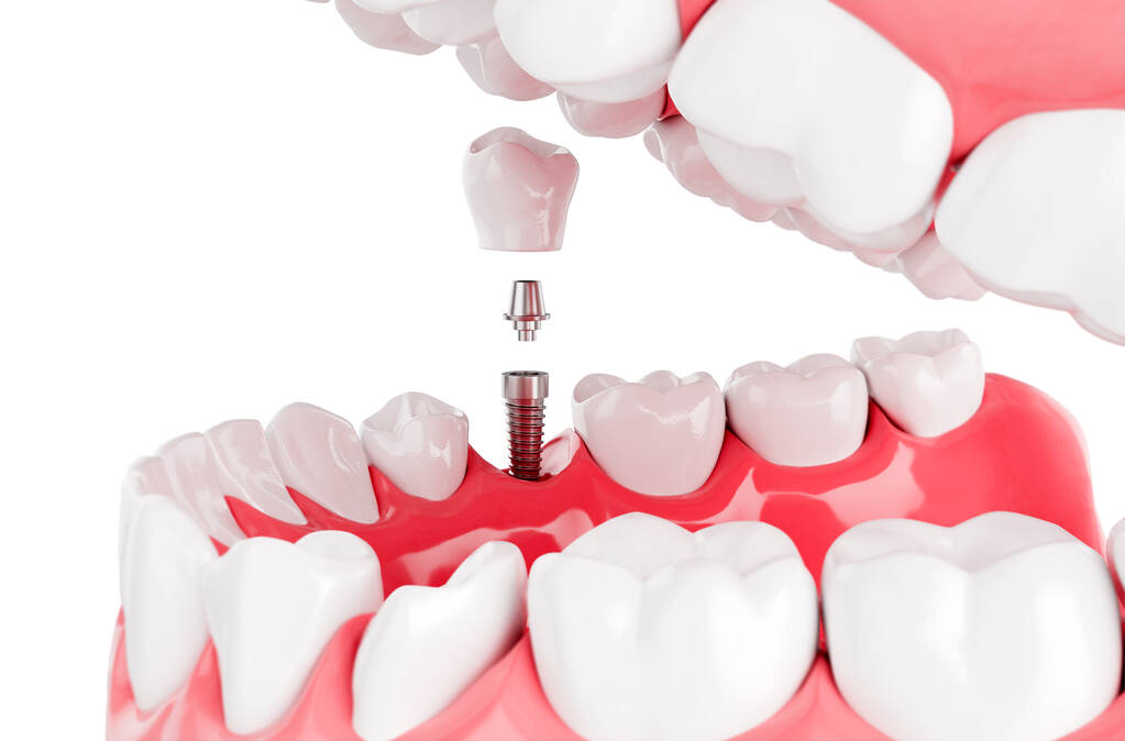 Costs Of Perth Dental Implants